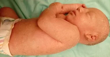 أيسل الهمص: رضيعة غزة تتحدى مرضاً وراثياً نادراً في ظل الأزمات الإنسانية