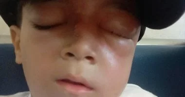 زين الدين محمد: طفل غزة الذي يقاوم الموت بسبب تشوه شرياني وأمل العلاج يتلاشى