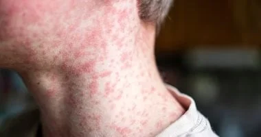 ارتفاع حالات الحصبة في أمريكا إلى أعلى مستوى منذ 32 عامًا: تسجيل 2318 إصابة جديدة