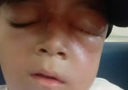 زين الدين محمد: طفل غزة الذي يقاوم الموت بسبب تشوه شرياني وأمل العلاج يتلاشى